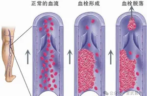 踝泵运动：全方位指南助你轻松掌握