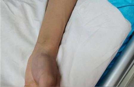 云南15岁学生遭宠物蜘蛛攻击，医护人员惊骇不已